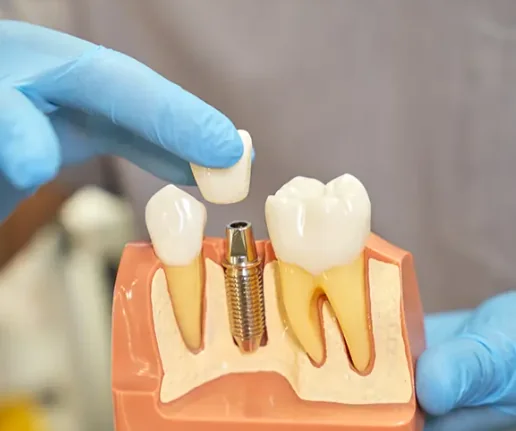 Implantes y Prótesis Dentales Odonto Ávila