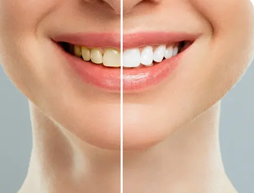 Limpieza y Blanqueamiento Dental Odonto Ávila